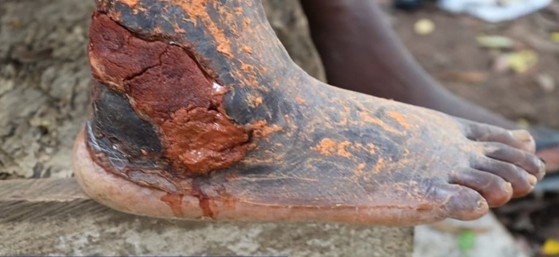 GLOMEF Appeals for Support for Skin-NTD Victims; Calls for Inclusion of NTDs in Global Health Funding