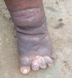 GLOMEF Appeals for Support for Skin-NTD Victims; Calls for Inclusion of NTDs in Global Health Funding